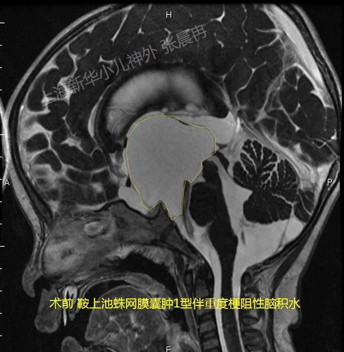 蛛网膜囊肿 - 好大夫在线