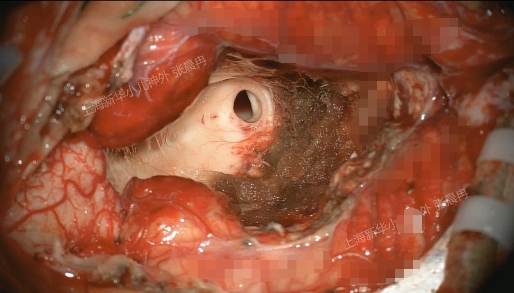 髓母细胞瘤的手术策略 - 好大夫在线