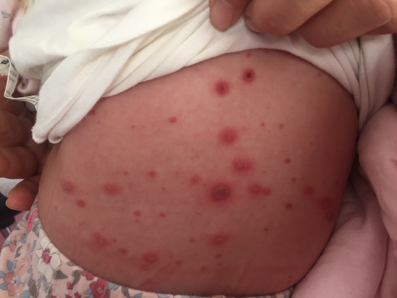 水痘可以洗澡吗 水痘科学护理系列 水痘 日常护理 水痘可以洗澡吗 水痘科学护理系列 水痘 日常护理