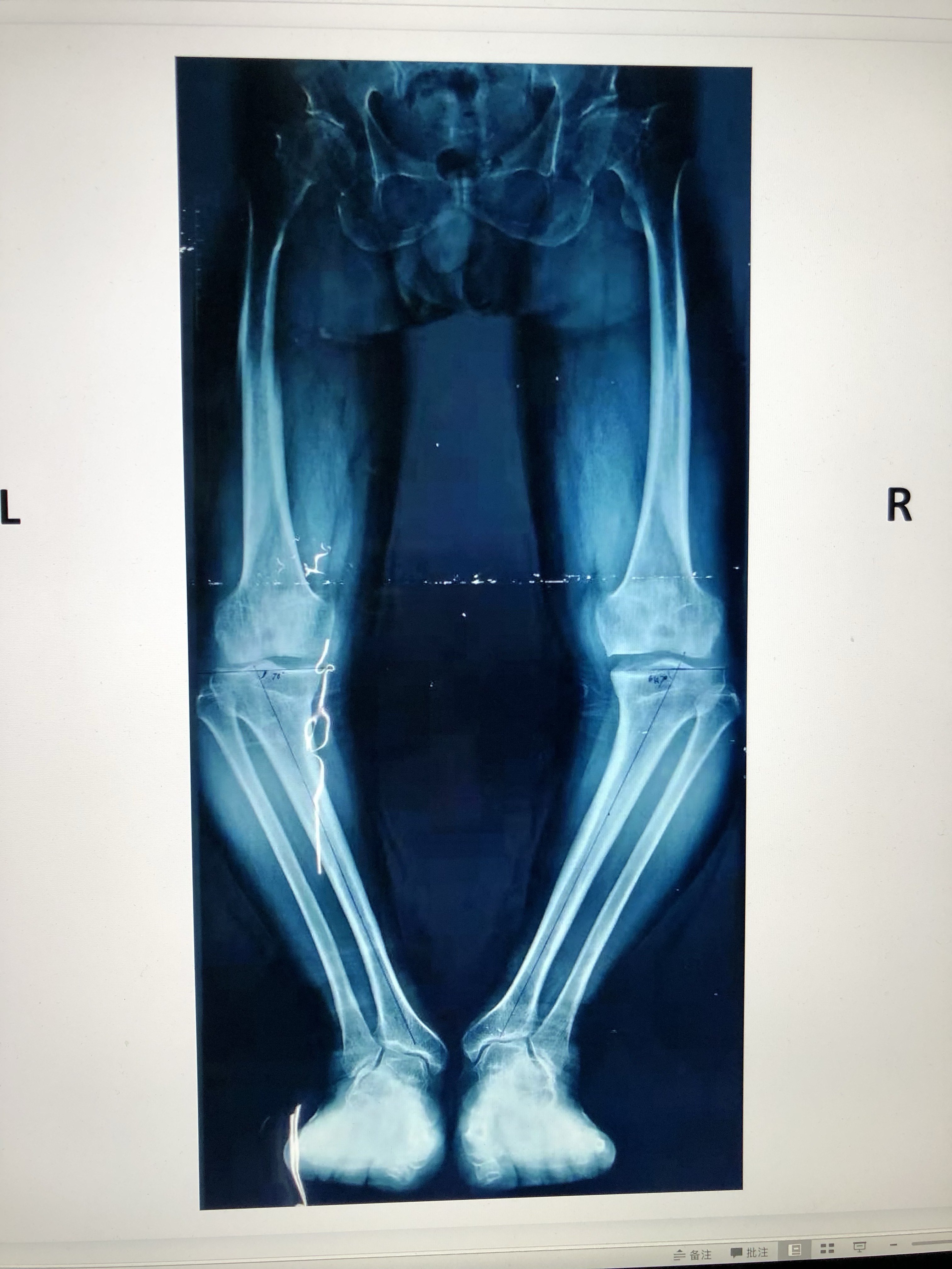 双膝严重畸形行双膝高位胫骨截骨术术后下肢力线恢复