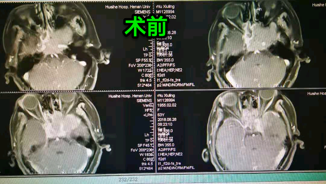 額顳斷顴弓入路復發垂體瘤切除術 李振江