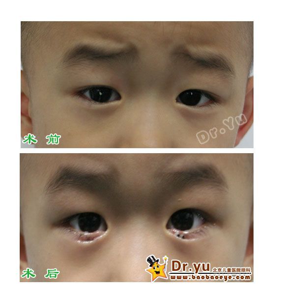 儿童倒睫手术前后图片图片