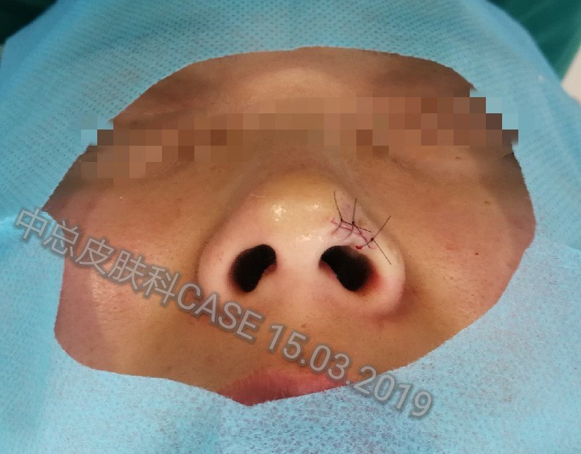 鼻部肿物手术切除术前和术后 - 好大夫在线