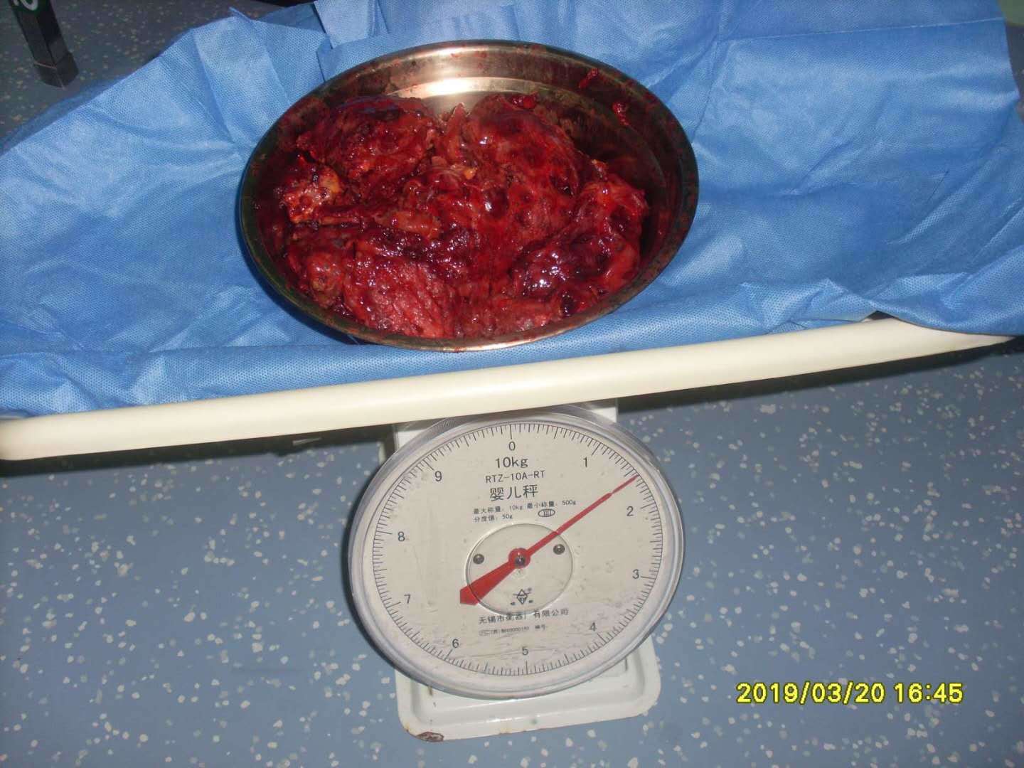 病例28--胆道来源腹膜假粘液瘤pmp - 好大夫在线