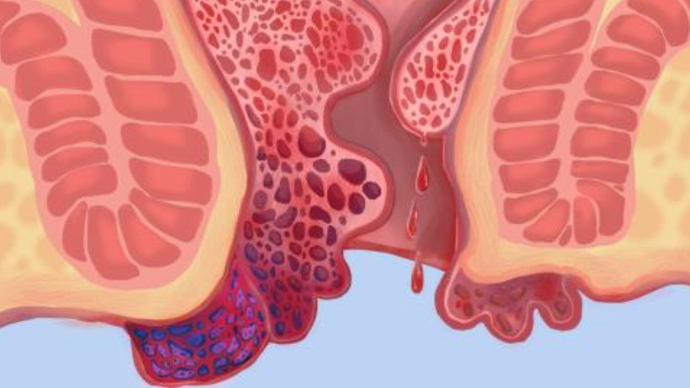 痔瘡手術後感染的症狀和治療方法