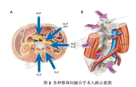 很好地观察神经根,牵拉硬膜囊显露椎间隙,切除椎间盘,准备终板和椎