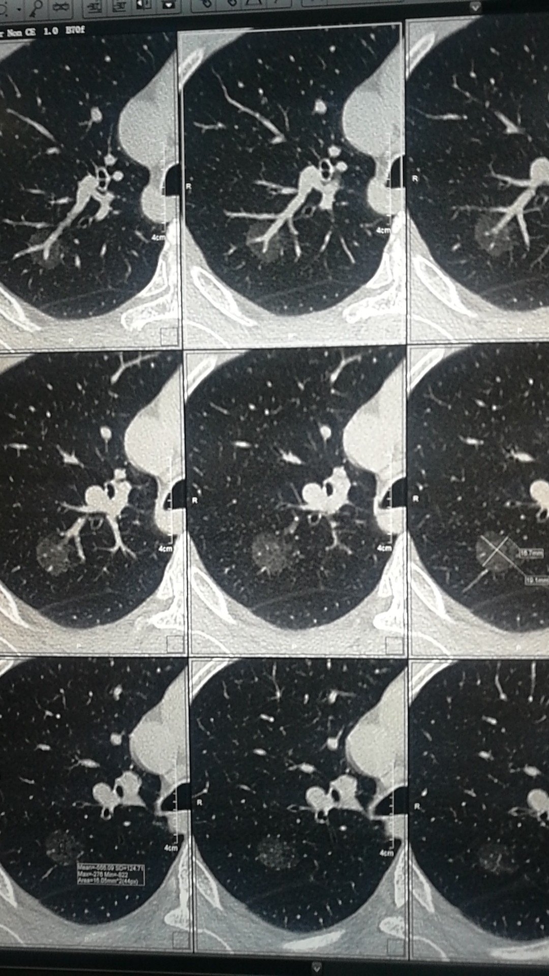 磨玻璃密度结节大不同