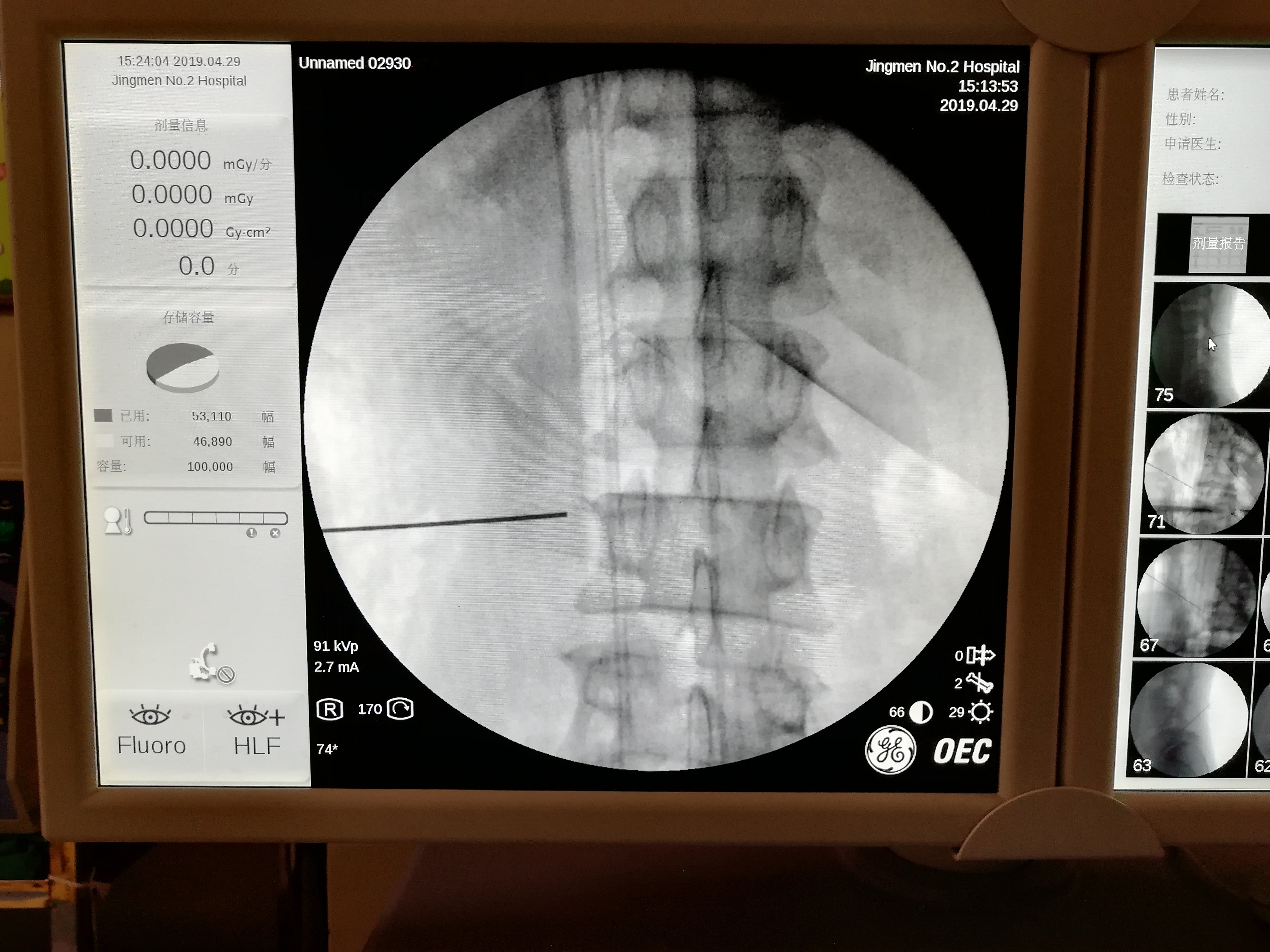 超声定位脊神经后支阻滞即刻缓解腰痛 - 好大夫在线