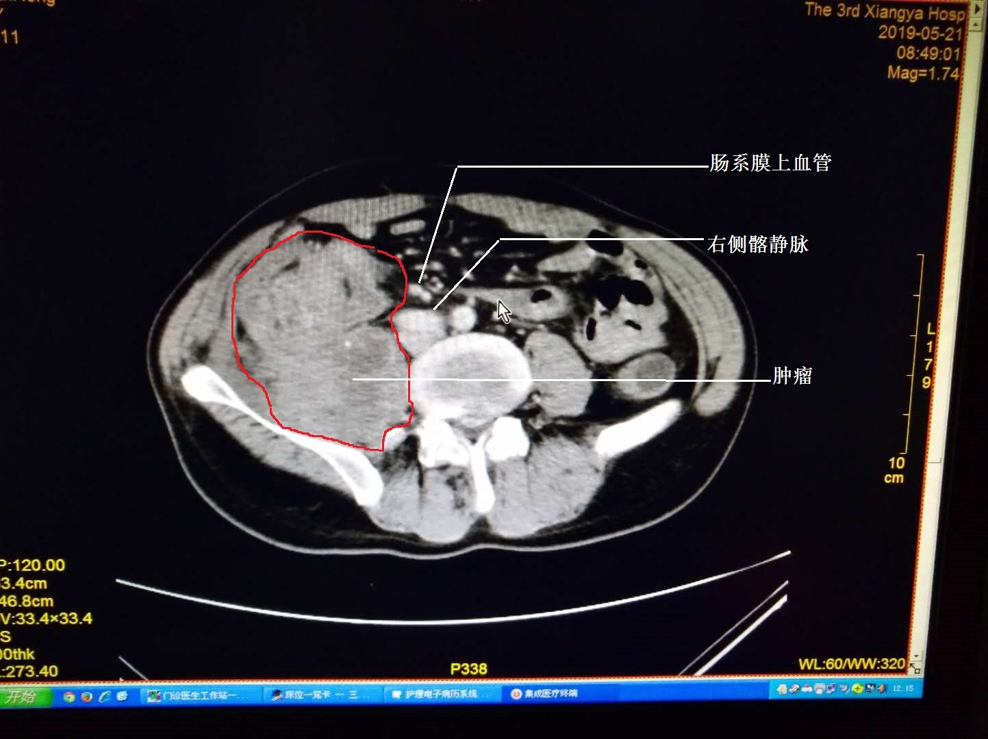 升結腸癌侵犯到背脊骨,累及髂血管,輸尿管,腰大肌,髂腰肌以及十二指腸