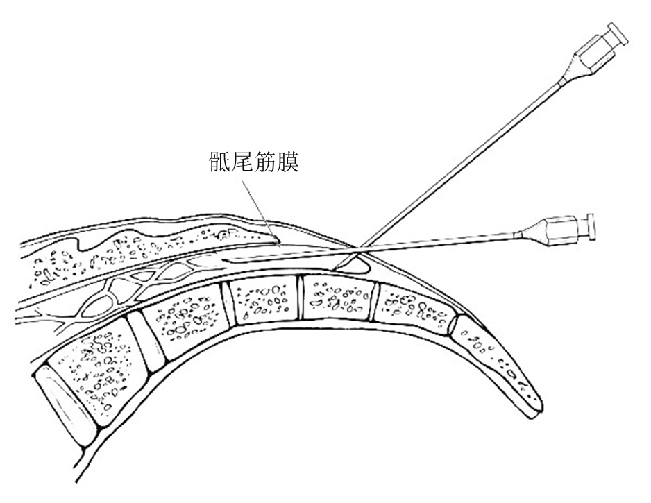 经骶管镇痛技术