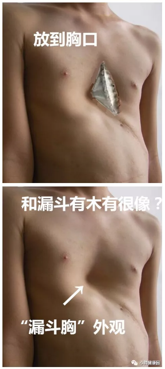 漏斗胸系列科普1 什么是漏斗胸 漏斗胸的危害和病因 漏斗胸 症状 病因 漏斗胸系列科普1 什么是漏斗胸 漏斗胸的危害和病因 漏斗胸 症状 病因