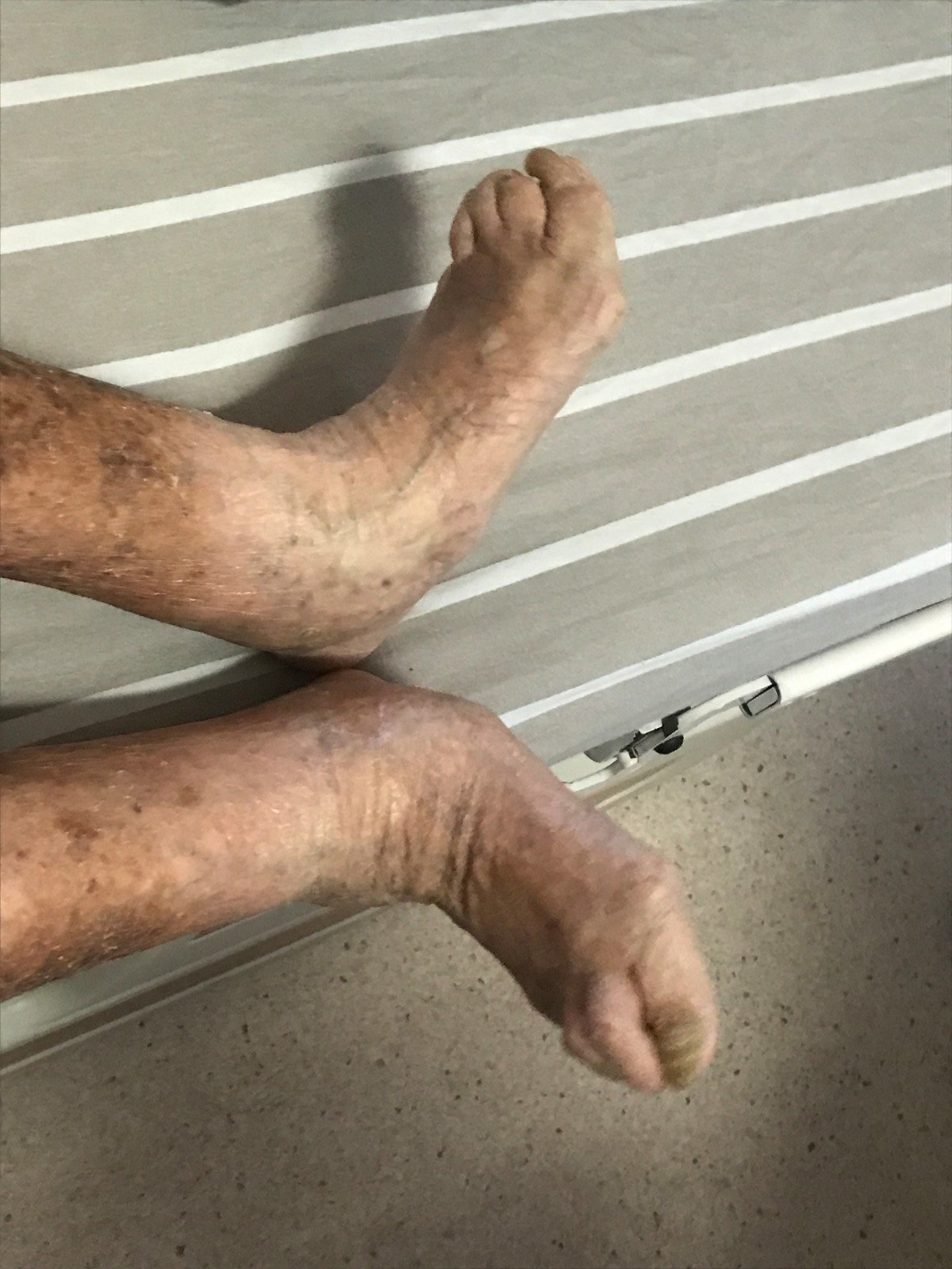 一般情况下很大可能是骨关节炎,也是通俗说的"骨质增生","长骨刺",是