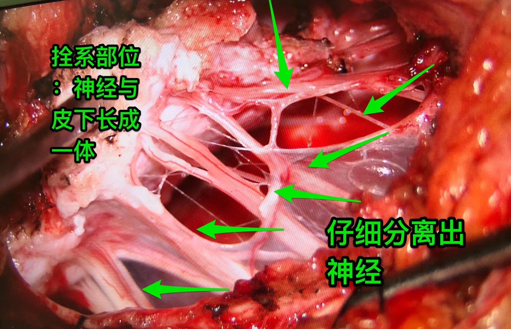 骨髓栓系图片