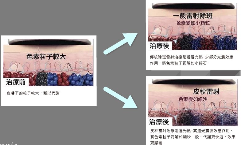 皮秒激光雷射祛斑 祛斑 祛斑