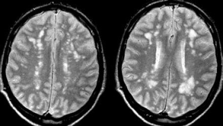 于大脑的白质区域,因此脑部脱髓鞘病灶也往往称之为 脑白质脱髓鞘病灶