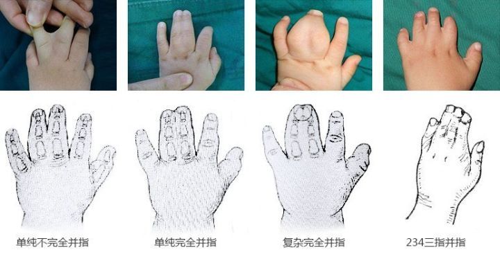 做完并指分离手术后注意事项_先天性并指多指畸形 - 好大夫在线