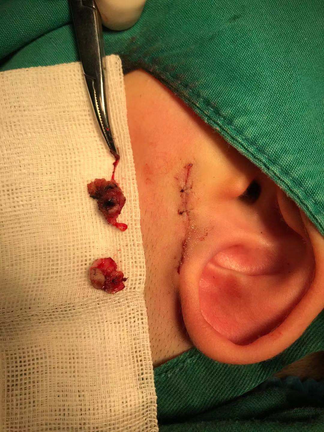 耳前瘘管切除手术图片