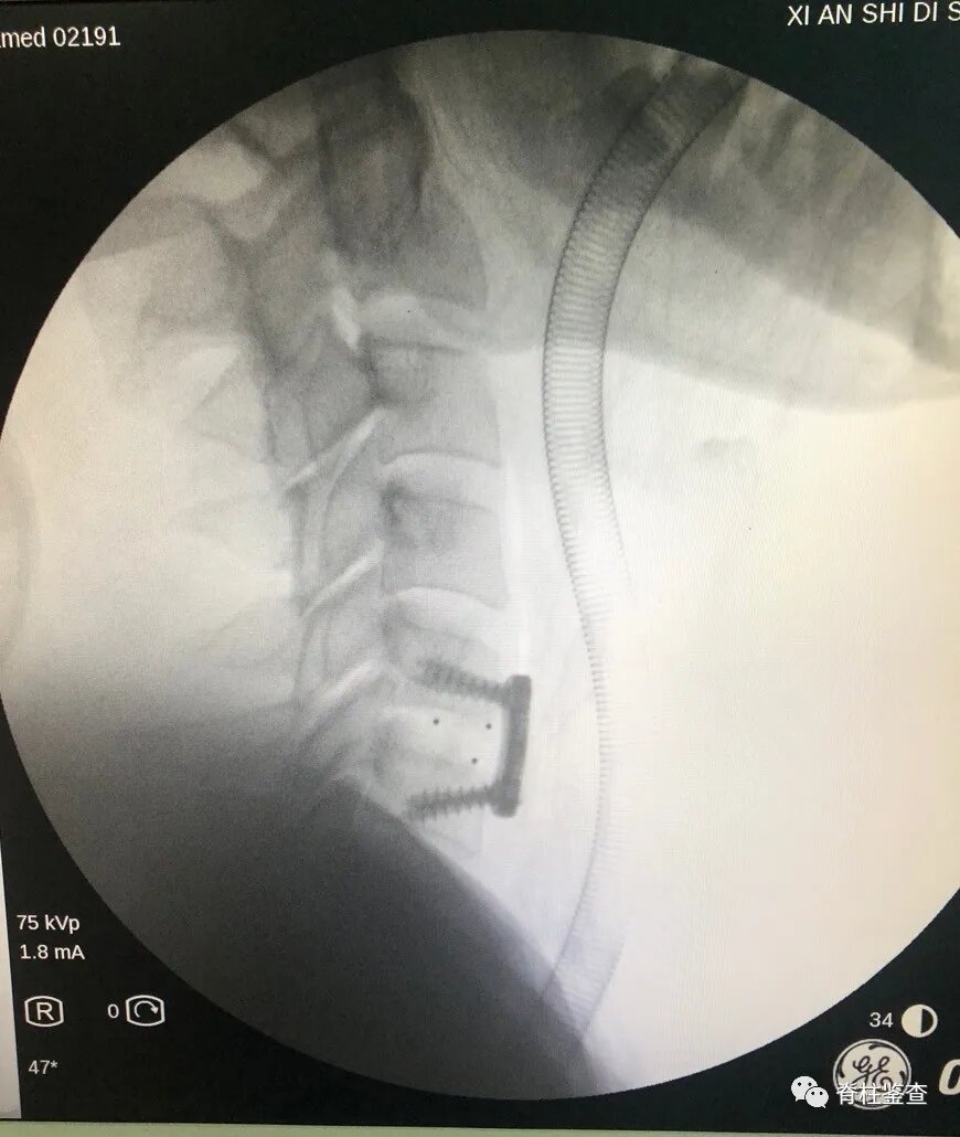 神经脊柱外科 满月 常见脊柱手术病例分享 颈椎病 颈椎病