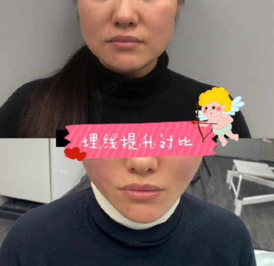 线雕_线雕治疗介绍 - 好大夫在线