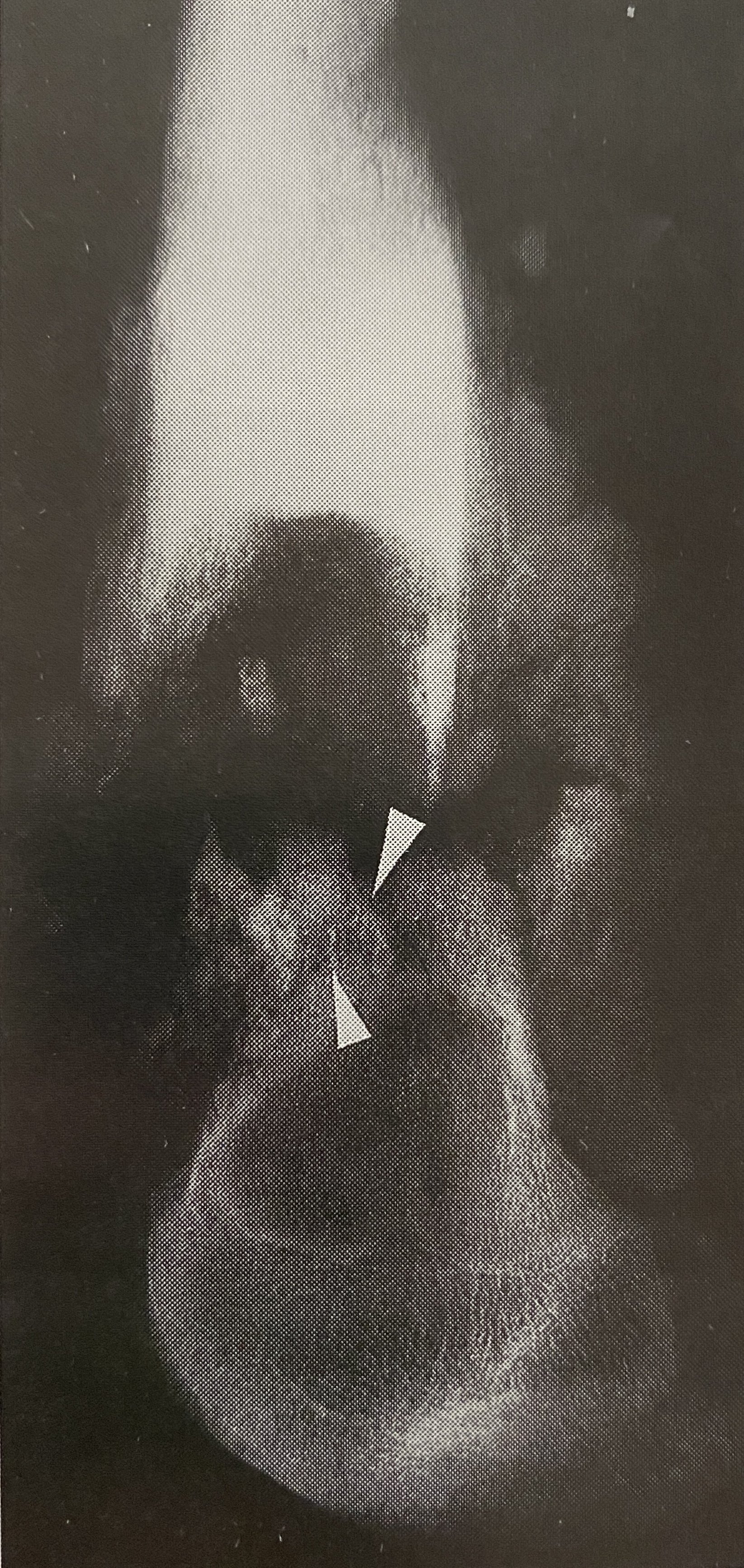 针状骨间的平行血管及棉絮样瘤骨 股骨下端骨肉瘤截肢标本x线微血管