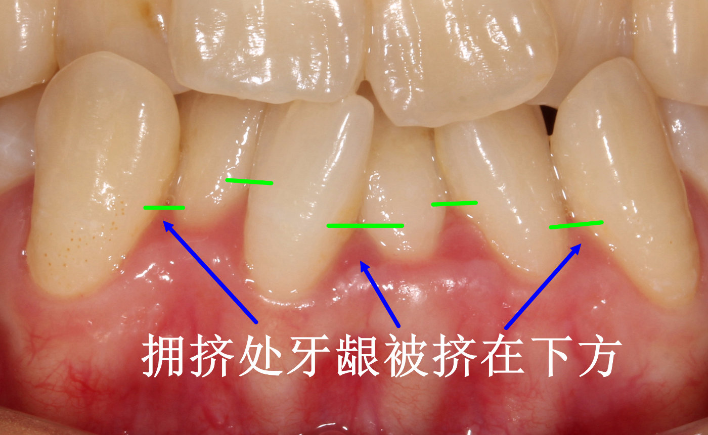牙龈乳头状图片