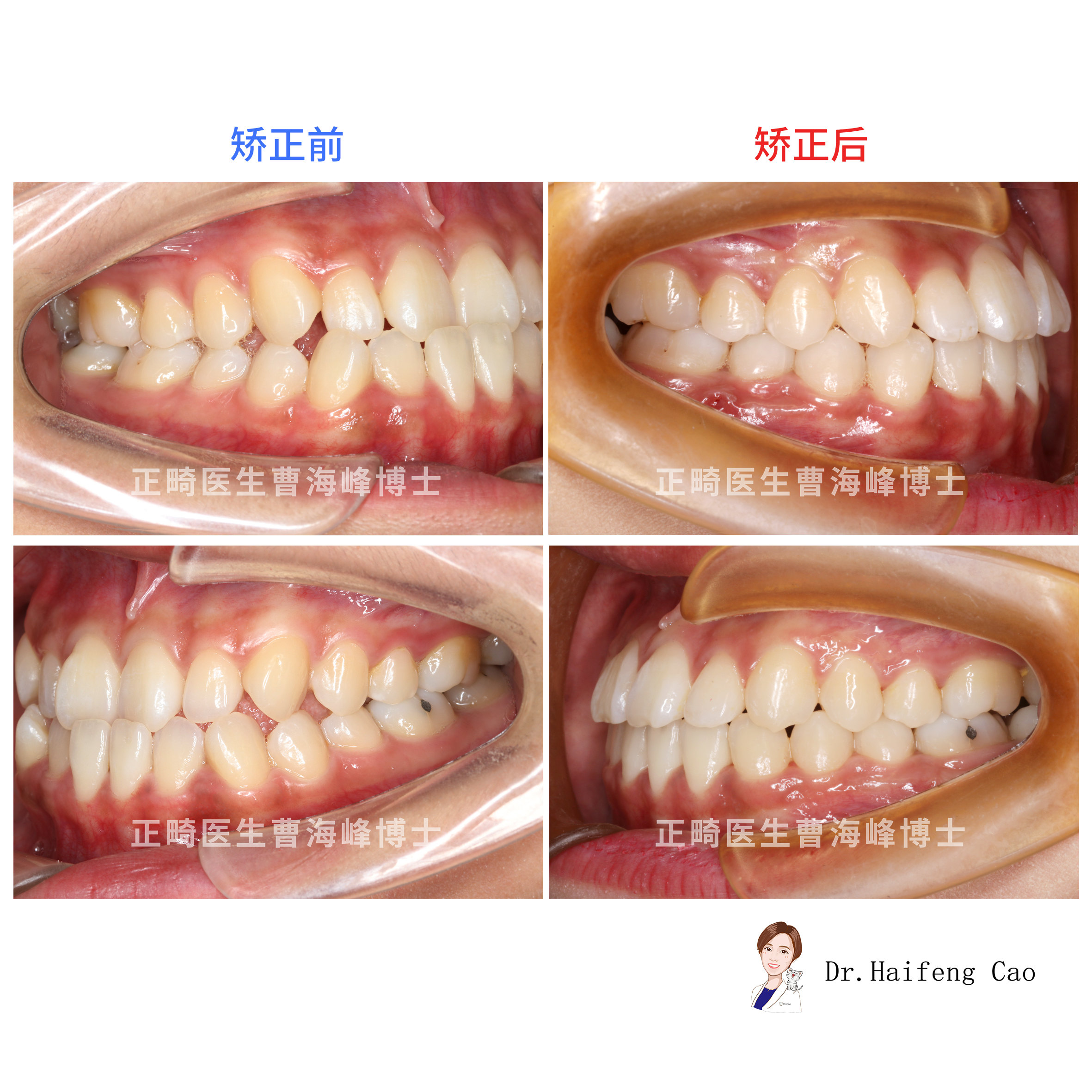 单纯正畸改善骨性地包天案例