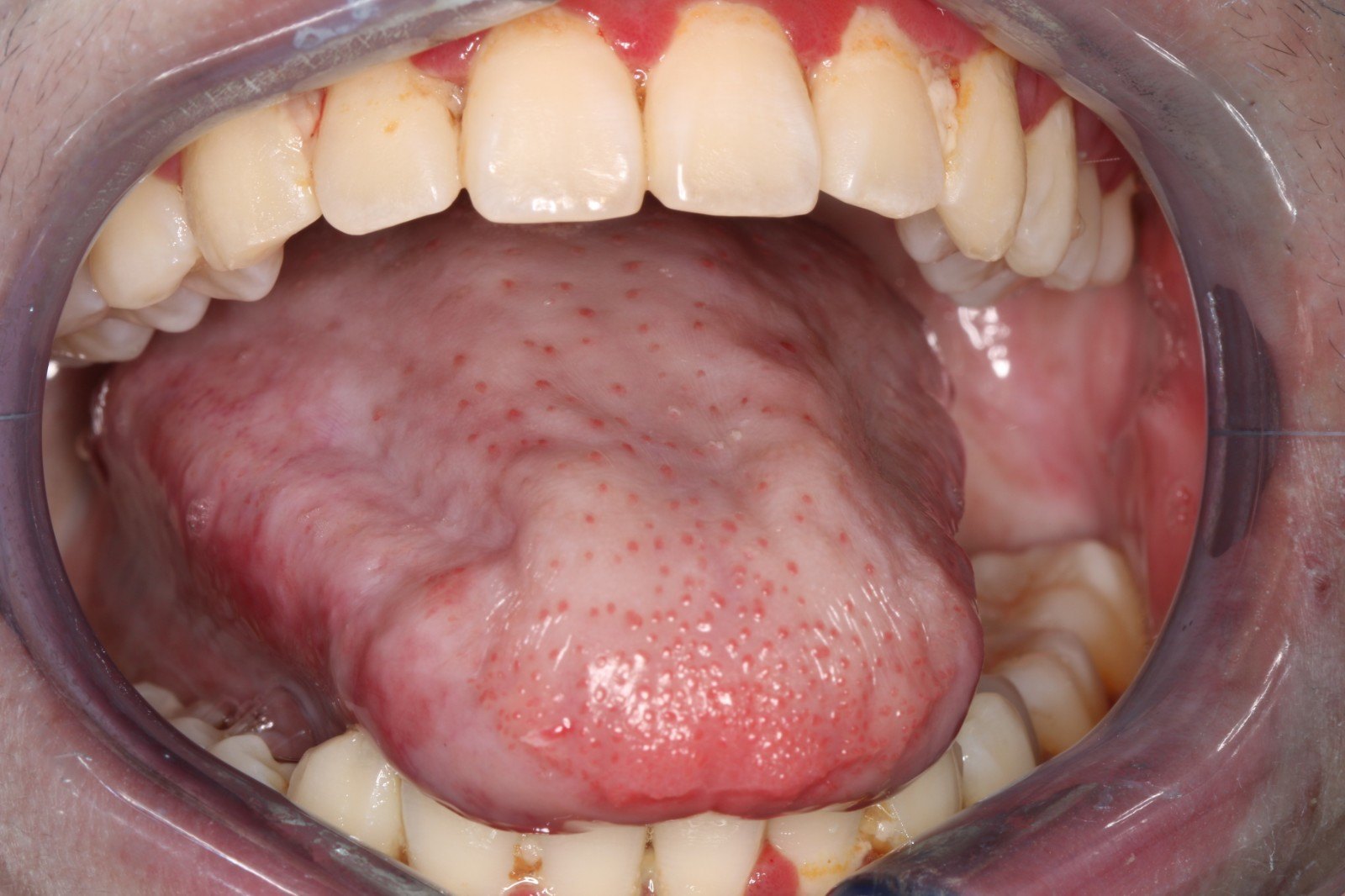 舌尖粘膜病的症状图片图片