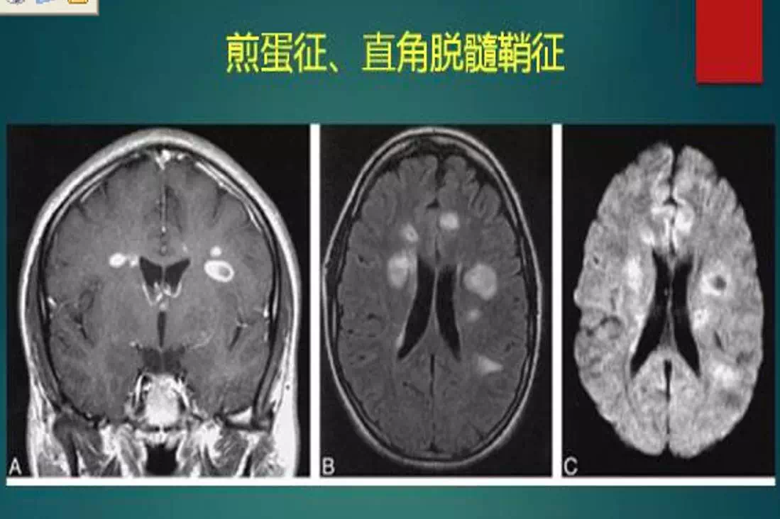 腔隙性脑梗死为哪般?小血管大病变!