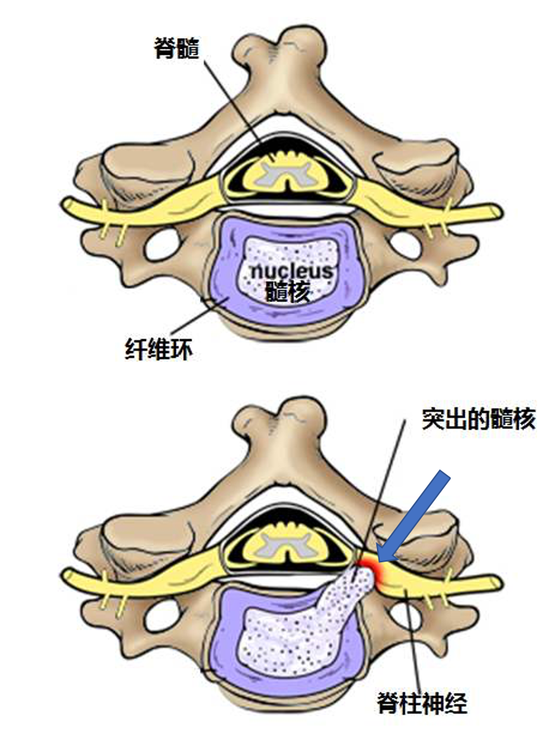 颈肩及上肢疼痛麻木神经根型颈椎病