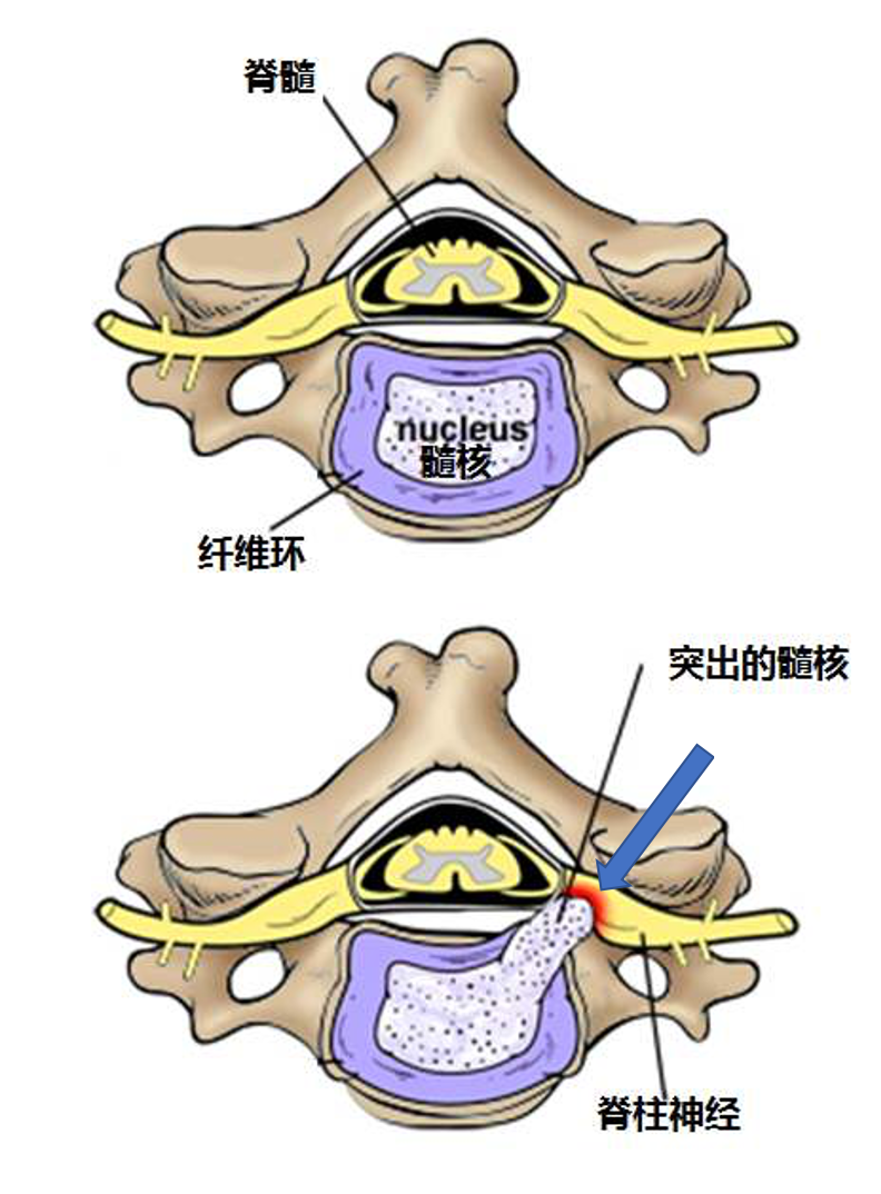 颈肩及上肢疼痛麻木---神经根型颈椎病_神经根型颈椎病 - 好大夫在线