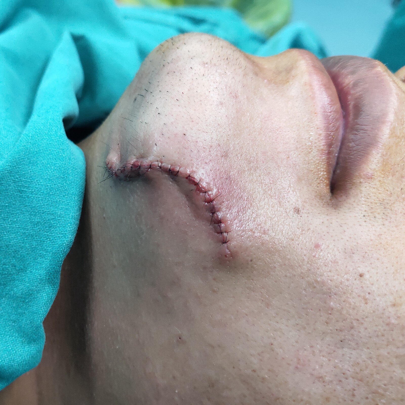 疤痕案例十四:下巴刀伤缝合后疤痕增生案例解析 