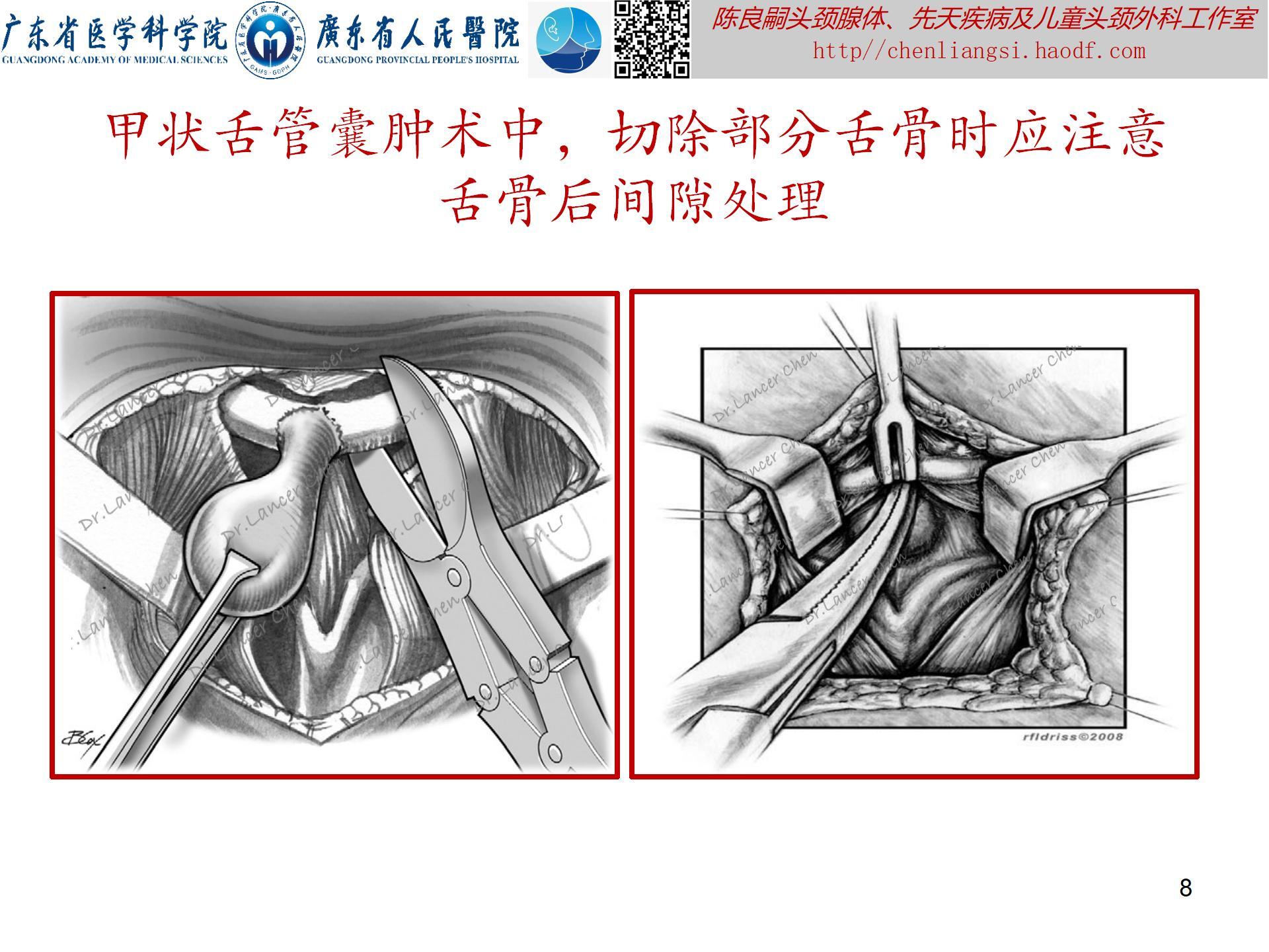 20240621：医学科普——百密一疏：舌骨后间隙的忽略，可导致甲状舌管囊肿术后复发_08.jpg