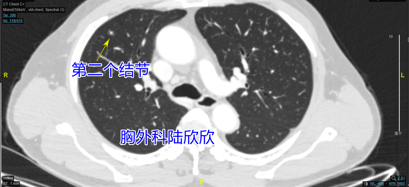 第2个结节 - 副本.png