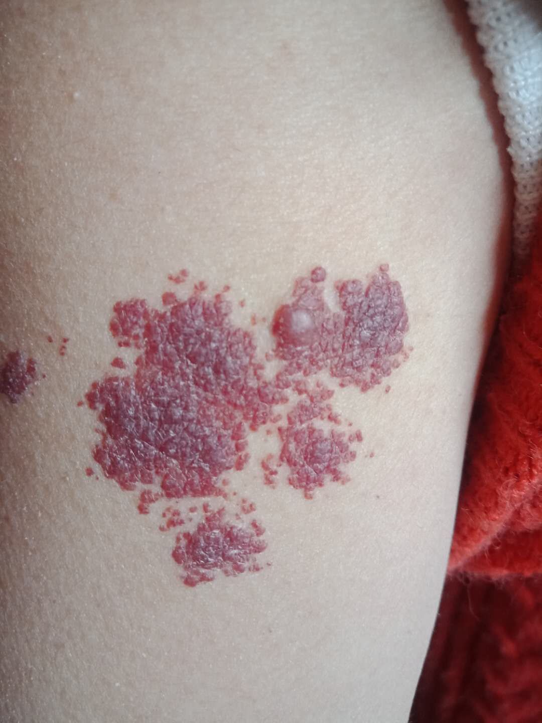 其他肿瘤性皮肤病也可表现为红斑,如蕈样肉芽肿.