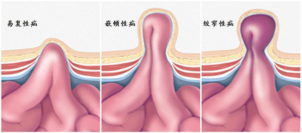 男性睾丸疝气图片图片