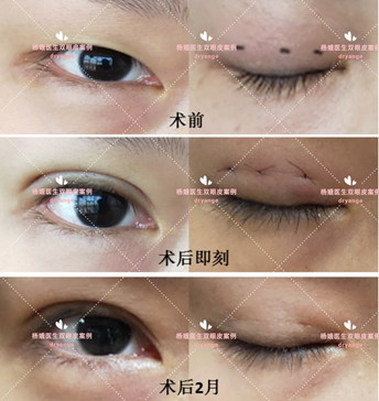 微创双眼皮与全切双眼皮的区别_双眼皮手术_双眼皮手术治疗介绍 - 好