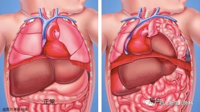1590461440264790.jpg 膈疝.jpg
