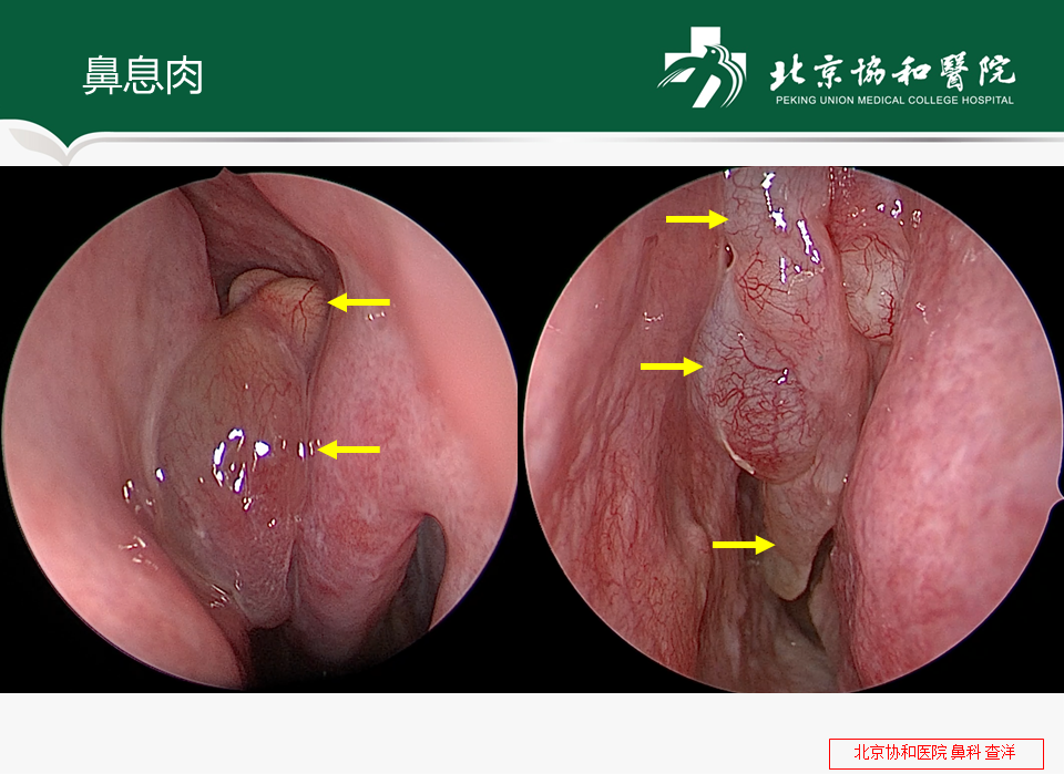 鼻息肉患者手术常见问题及注意事项 鼻息肉 手术 鼻息肉患者手术常见问题及注意事项 鼻息肉 手术