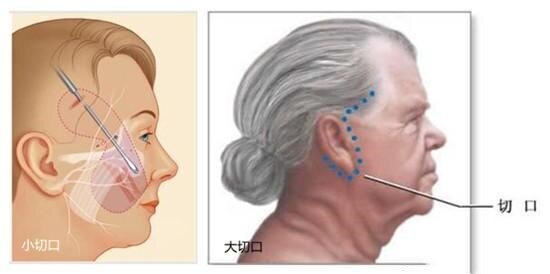 面部皮纹切口选择图图片