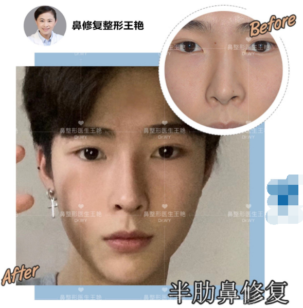 鼻修复用什么材料比较好 鼻整形修复 鼻整形修复 鼻修复用什么材料比较好 鼻整形修复 鼻整形修复