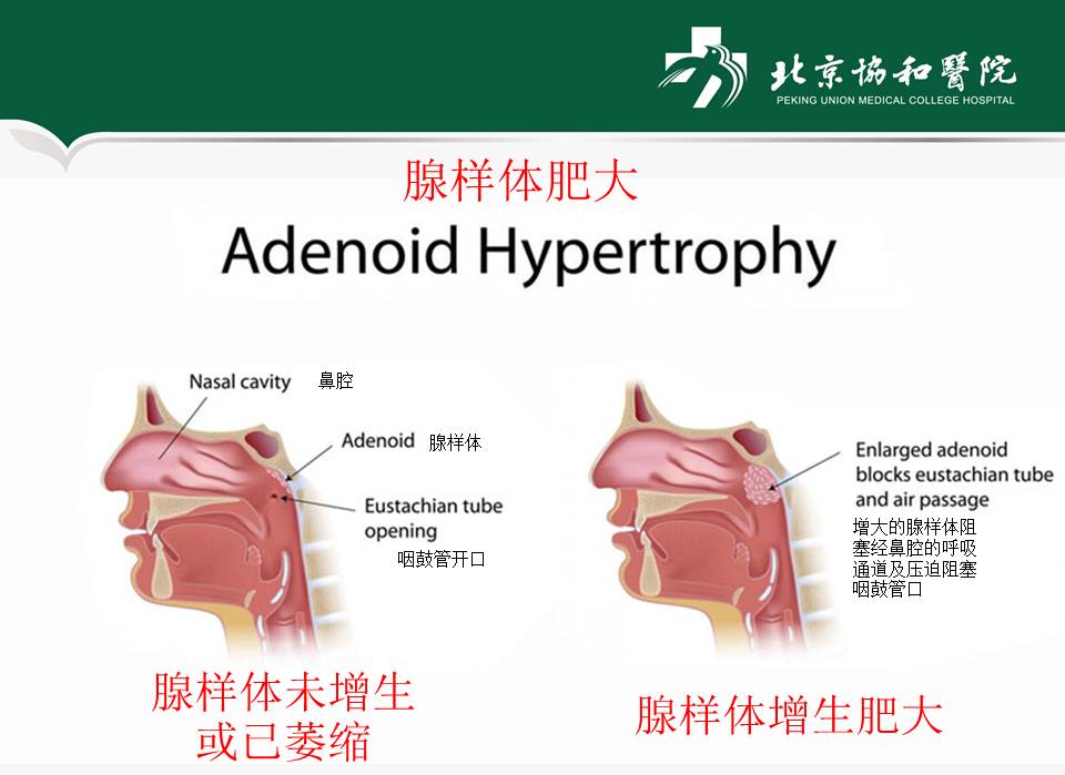 腺样体肥大的危害以及是否必需要手术 小儿腺样体肥大 介绍 治疗方式 好大夫在线