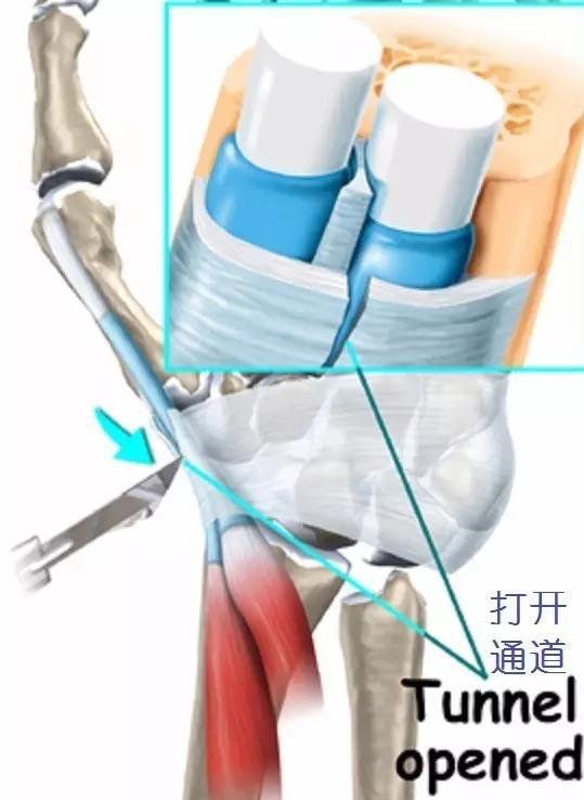 狭窄性腱鞘炎手术图解图片