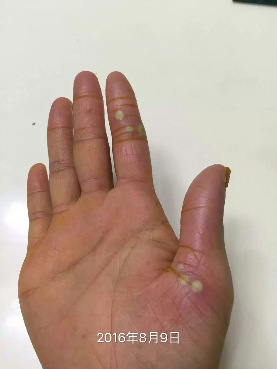 经方治疗掌跖脓疱病1例