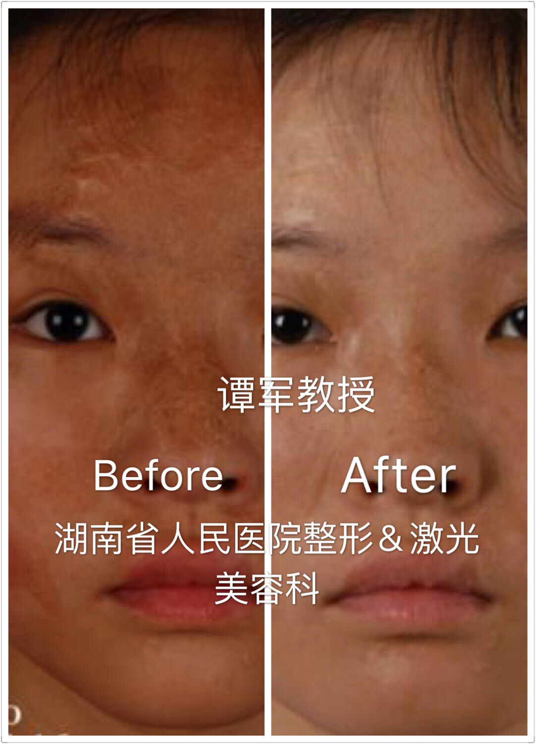 浅表性疤痕的点阵激光皮肤再生原理及案例集 - 好大夫在线