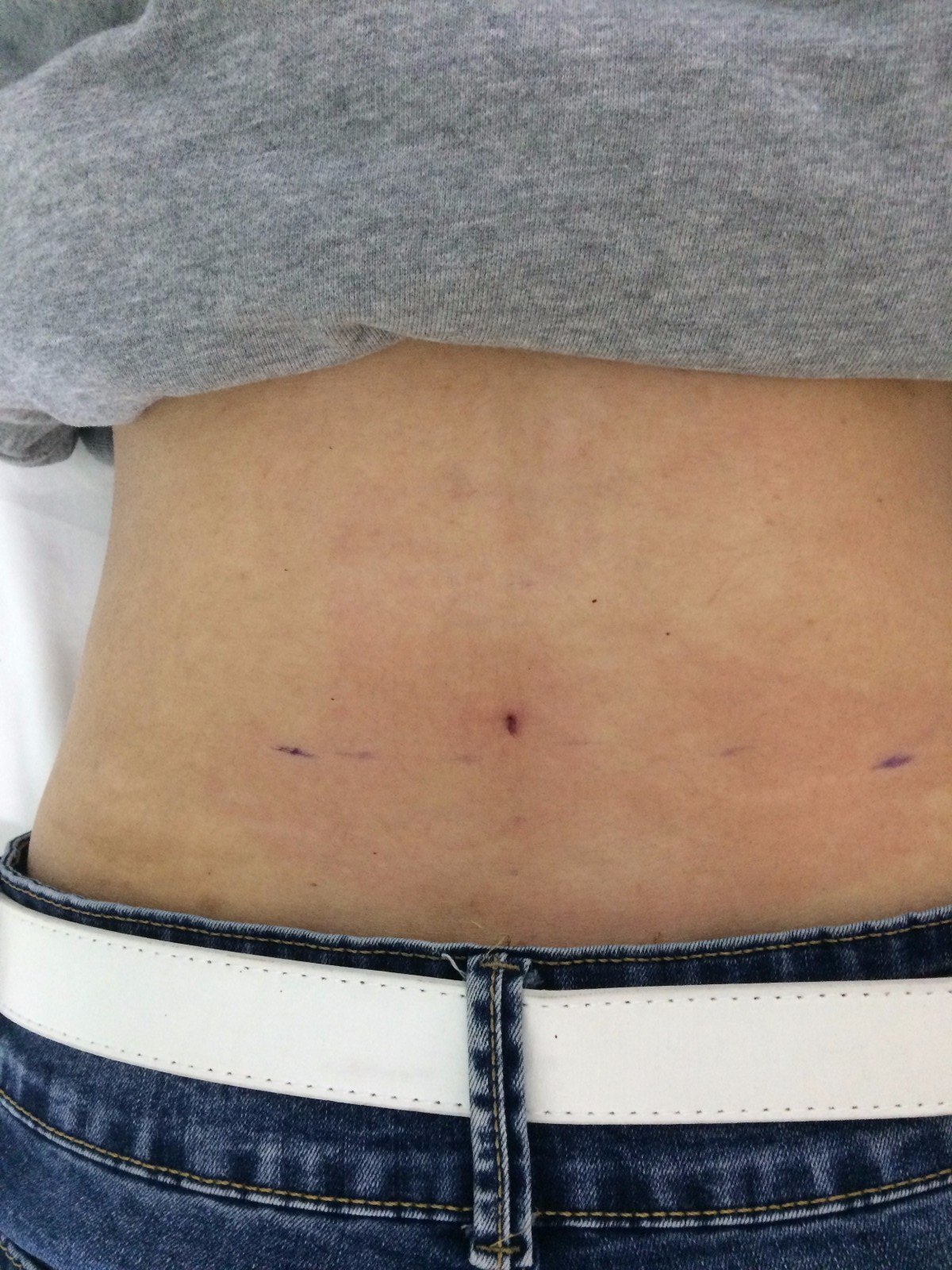 骆氏无痛挑背祛痔法,痔疮治疗的新选择!