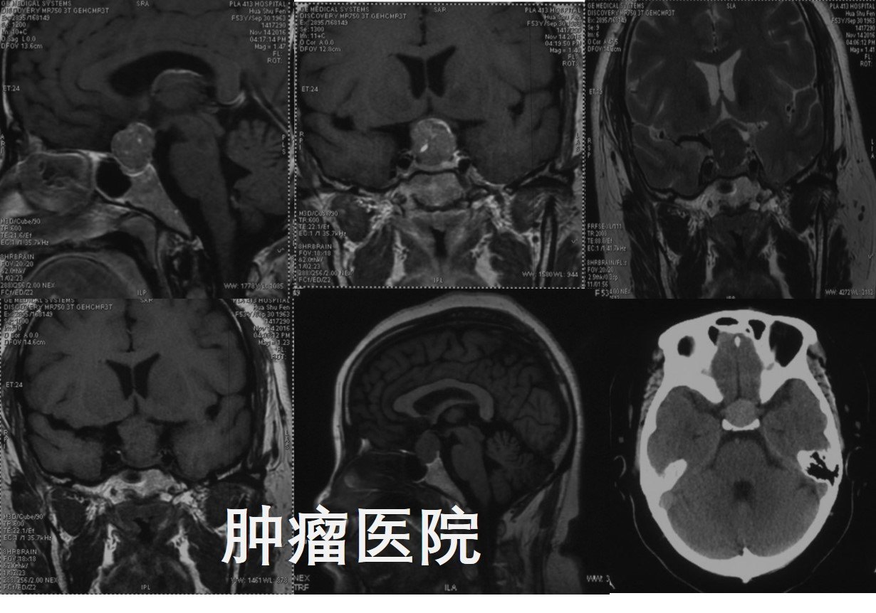 頭顱ct示:鞍區佔位性病變,呈等高密度,未見鈣化(圖1).