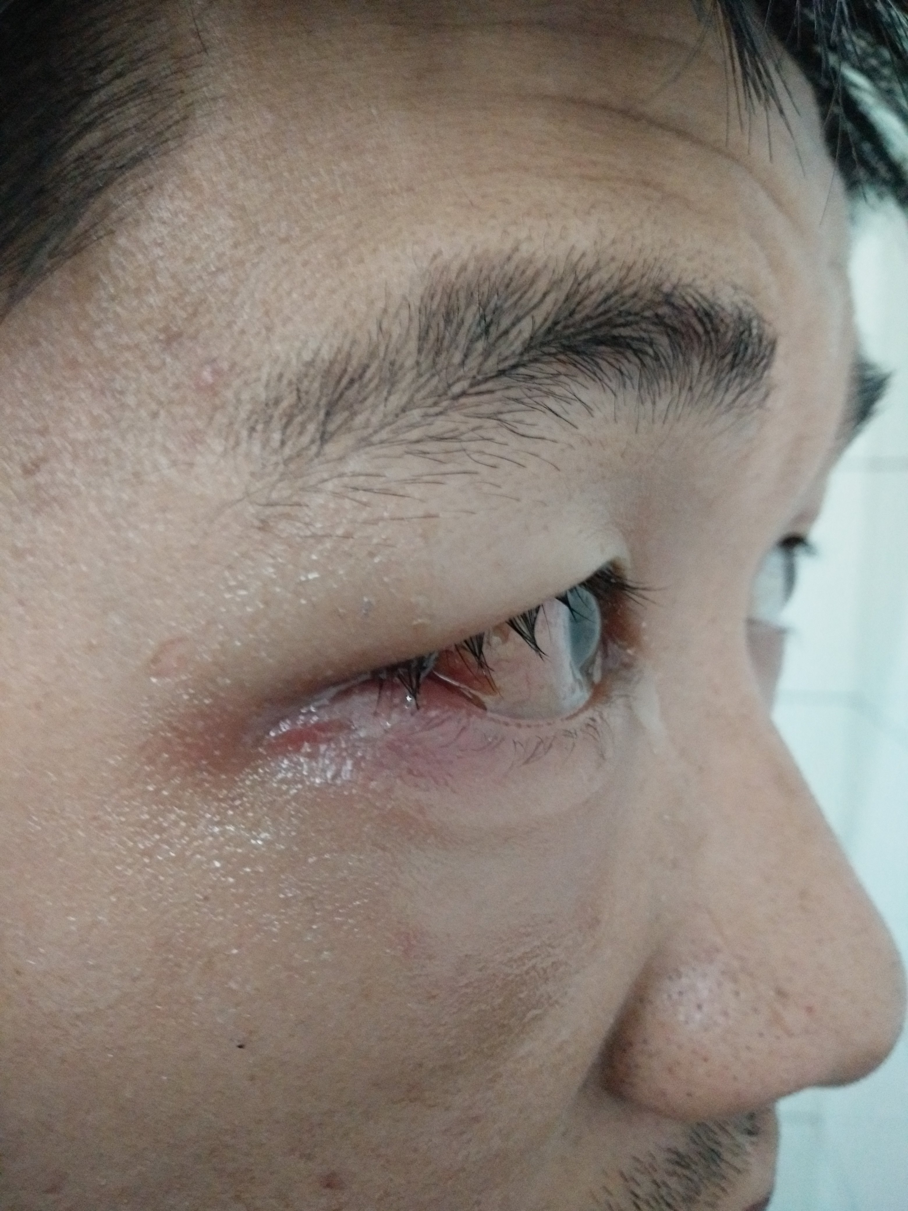 2018/12/28外伤导致的眶蜂窝织炎,眼内炎,眼球破裂伤,眼睑脓肿.