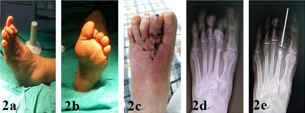 weil截骨治疗跖骨过长伴骑跨趾畸形 - 好大夫在线