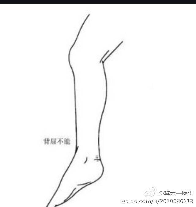 足下垂的原因及鉴别诊断 - 好大夫在线