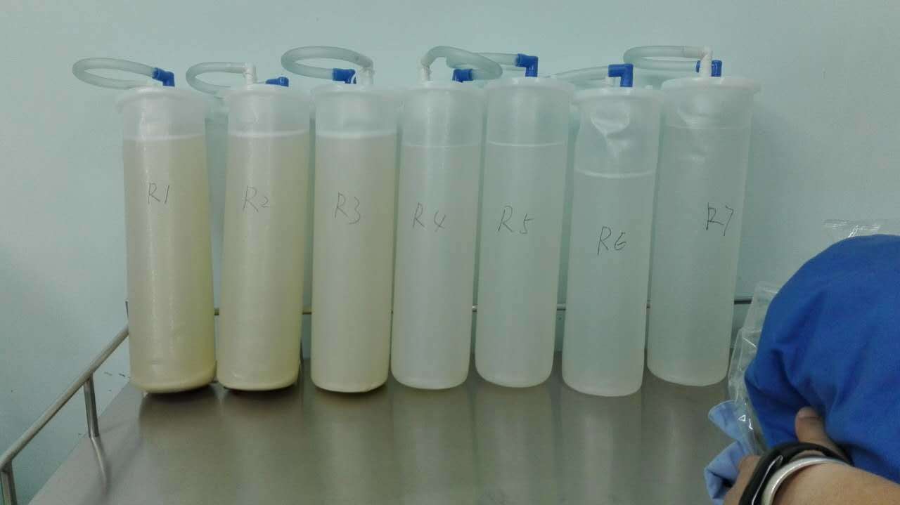 双肺大容量同期灌洗治疗肺泡蛋白沉积症 - 好大夫在线